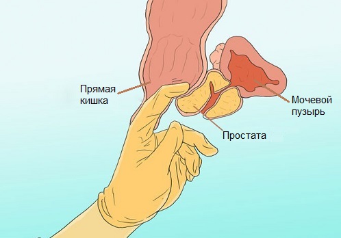Лечение аденомы простаты в Нижнем Новгороде | ТОНУС ПРЕМИУМ